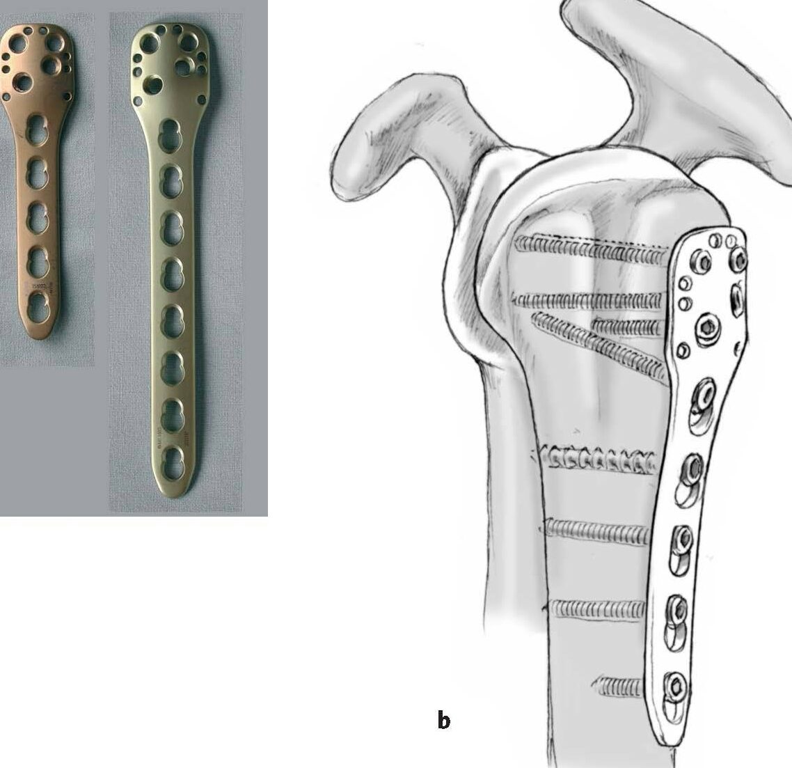 band locking que es y como hacerlo con criterio